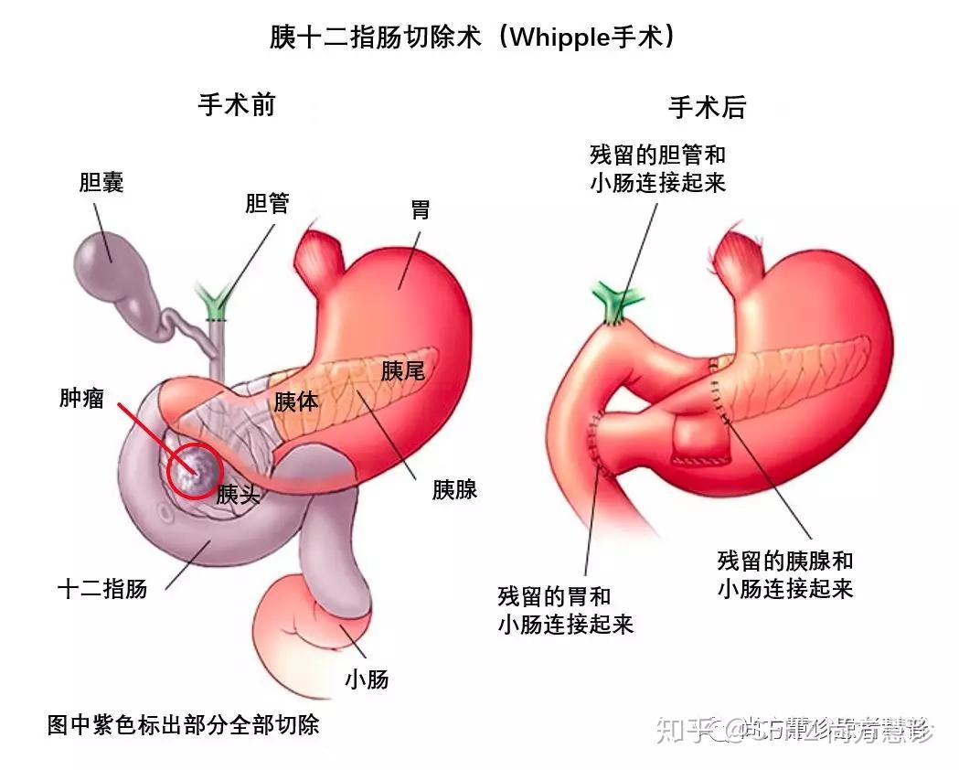 例如最常见的胰腺癌切除手术,肿瘤大小如图中红圈标出部分,但切除范围