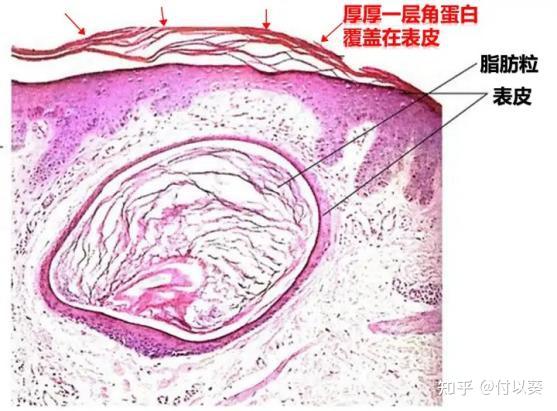 什么东西可以消除脂肪粒 v2-8a6be6ab4c4ddd7ac643012e03b0f80b_r.jpg