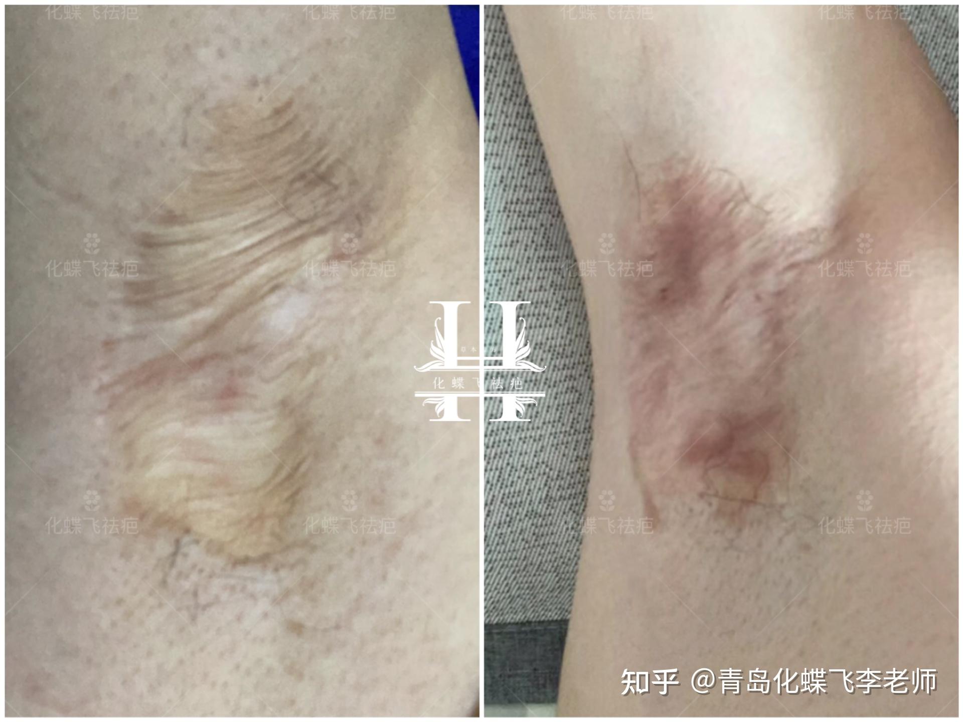 传统术式留下的腋下疤痕