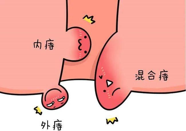 屁股擦不对痔疮找上门痔疮到底怎么预防不知道的看这里
