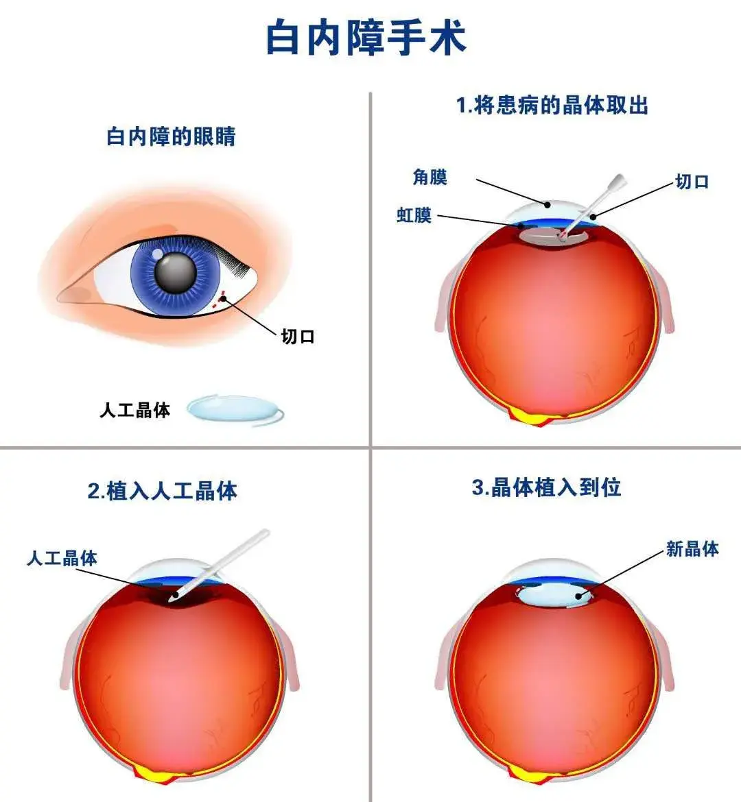 白内障手术后多久恢复图片