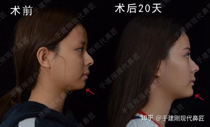 如何拥有一个完美侧颜 v2-8a8f9bb73789306a25bad1000008ce83_r.jpg