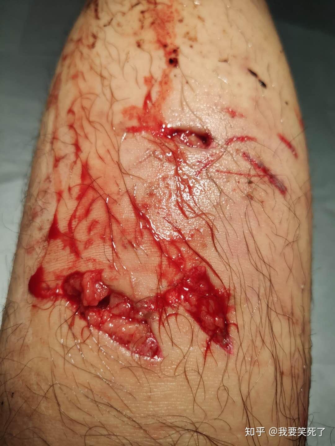 狂犬病毒伤口图片