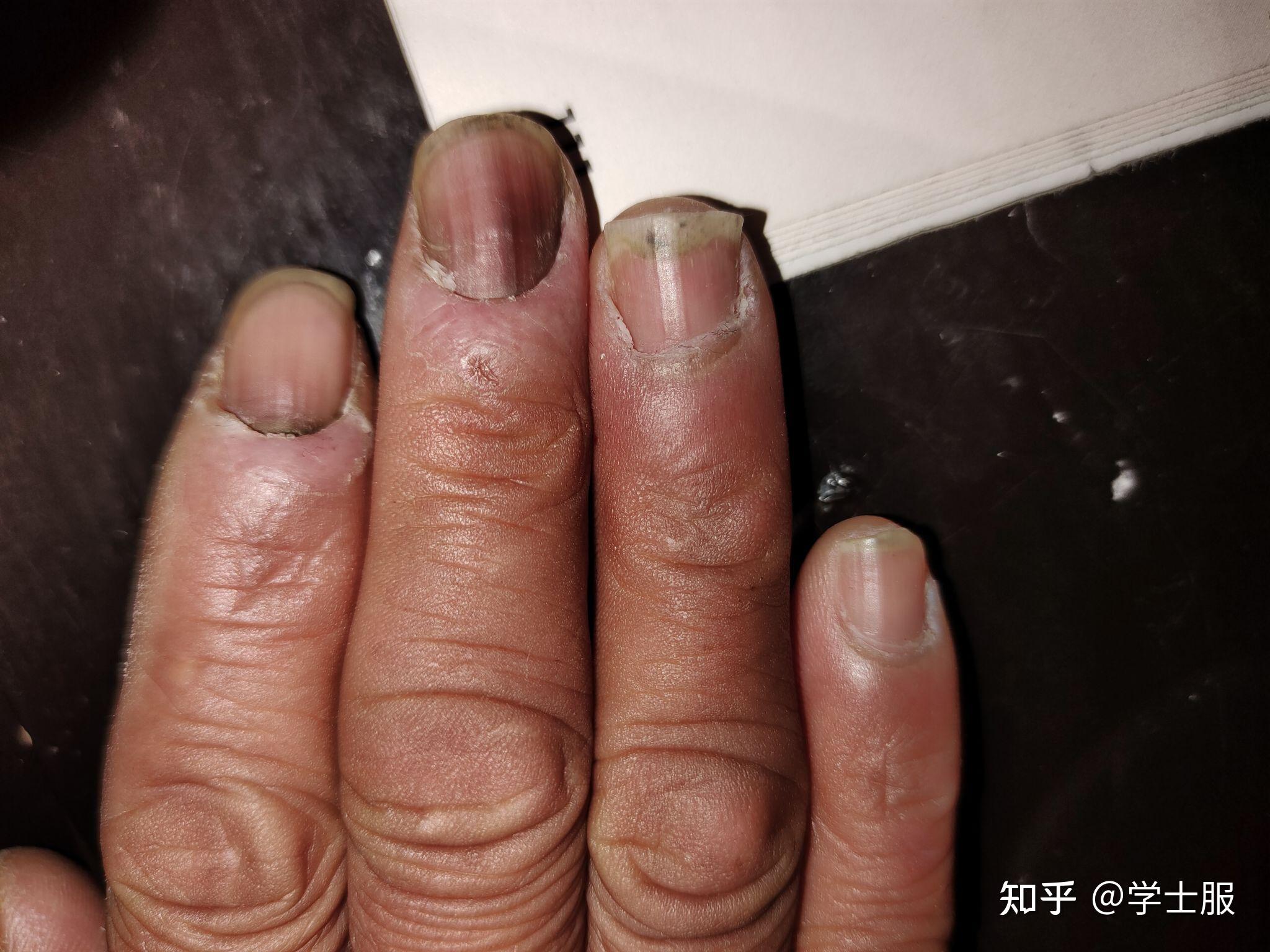 母亲最近手出现了问题,指甲变黑了,请问网友们这是灰指甲吗? 