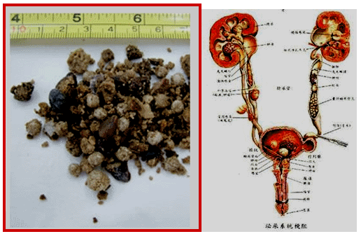 第三十八章 泌尿系结石病人的护理 - 知乎