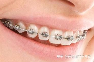 苏州牙齿矫正 如何避免牙齿矫正后反弹 知乎