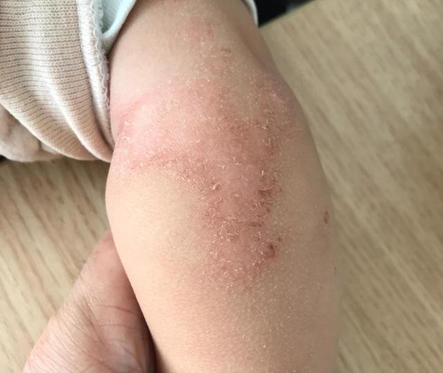 宝宝皮肤好不好取决于父母的态度