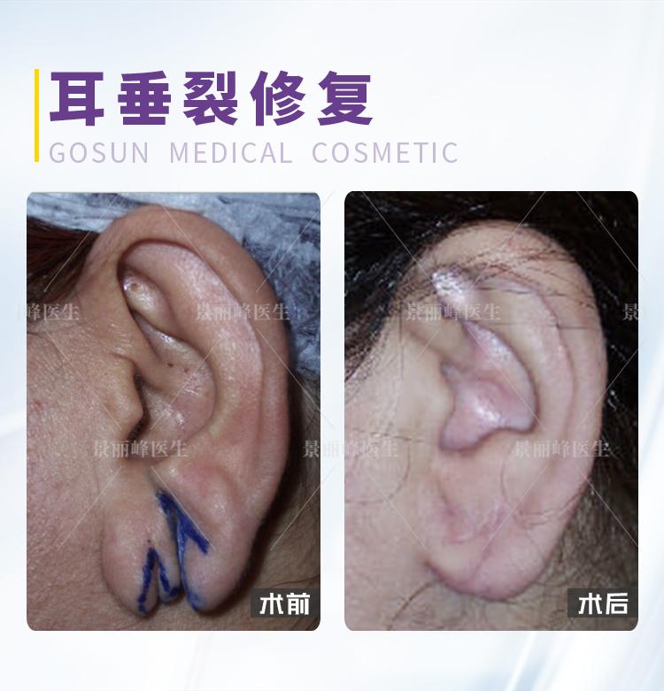 景医生科普为什么耳垂下面会裂开可以修复吗