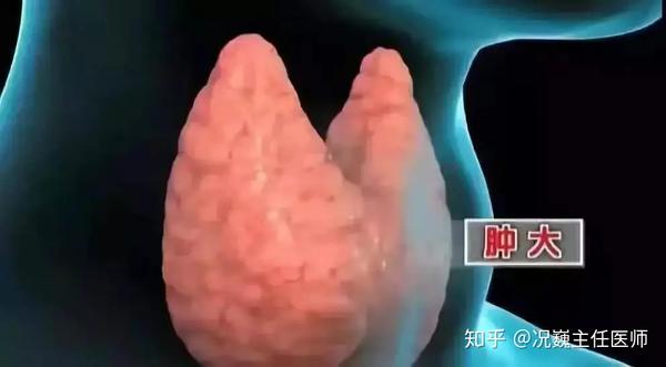 桥本氏甲状腺炎 能治愈吗 会不会癌变 知乎