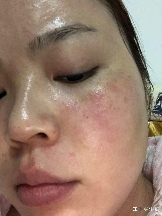 用了那么多东西遇到她我一年内治愈了激素脸