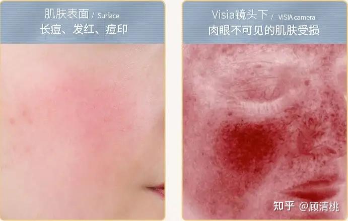 油皮适合什么护肤品?(油皮类型、油皮护肤重点,油皮如何护肤?)油皮护肤品推荐! - 知乎