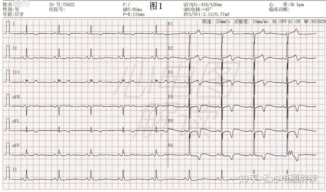心电图电压图片