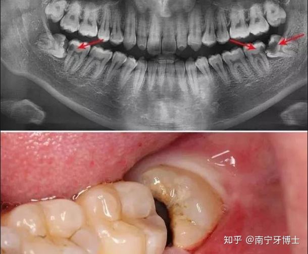 拔重叠牙危险图片