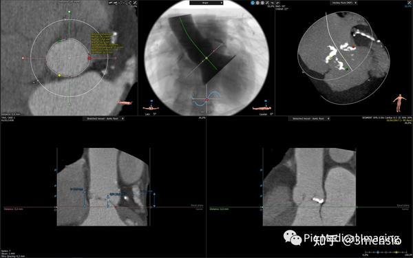 3mensio-aortic