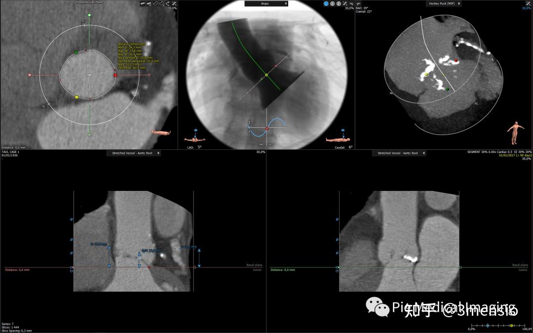 3mensio aortic 