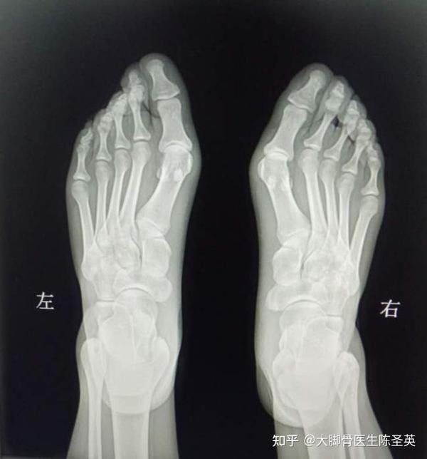 大脚骨 真的是脚骨变大了吗 知乎 大脚骨 真的是脚骨变大了吗 知乎