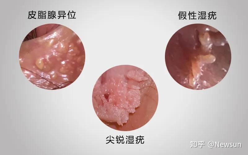 尖锐湿疣与假性湿疣区别(内附图片)