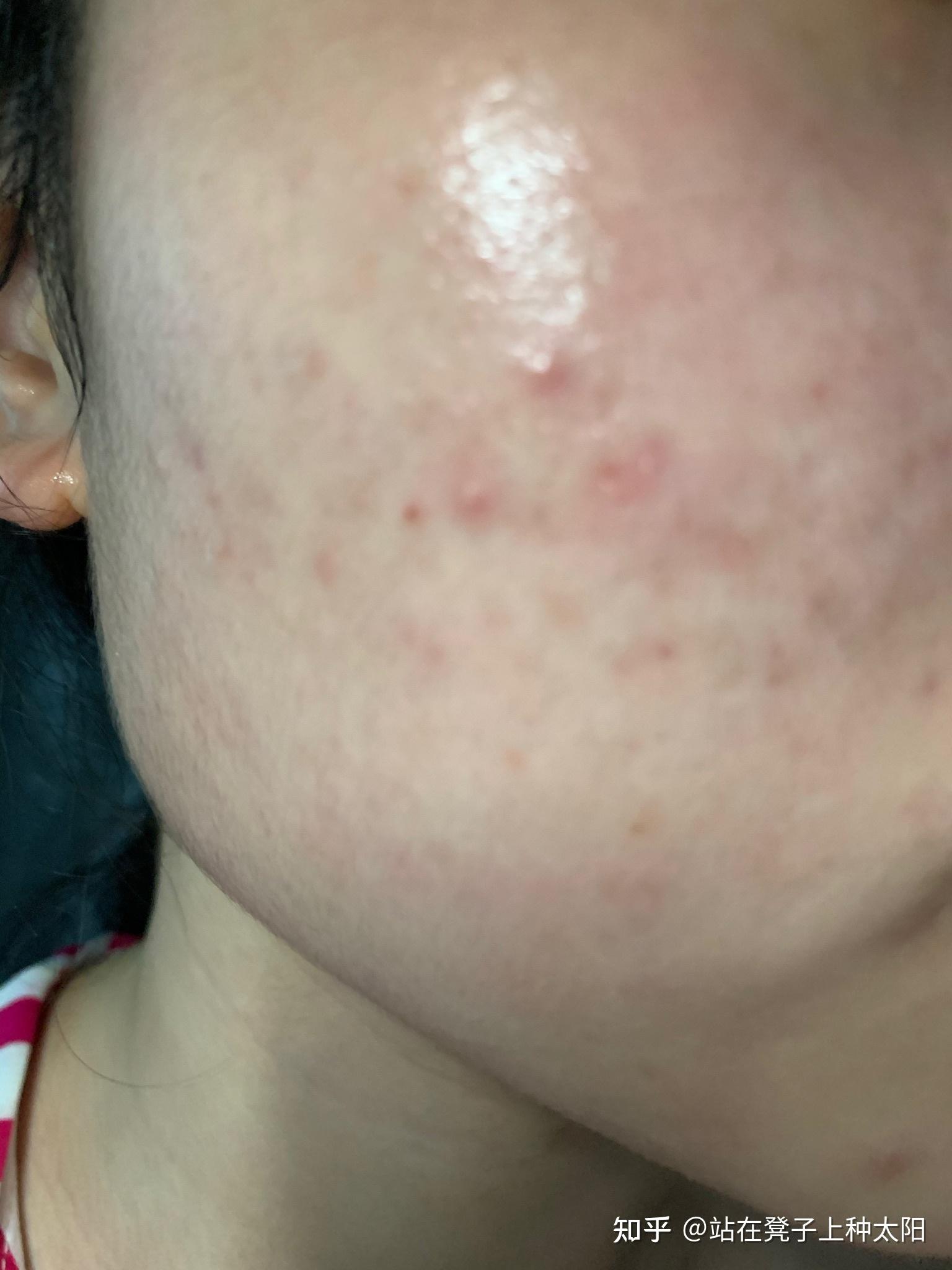 记录使用阿达帕林凝胶 - 知乎