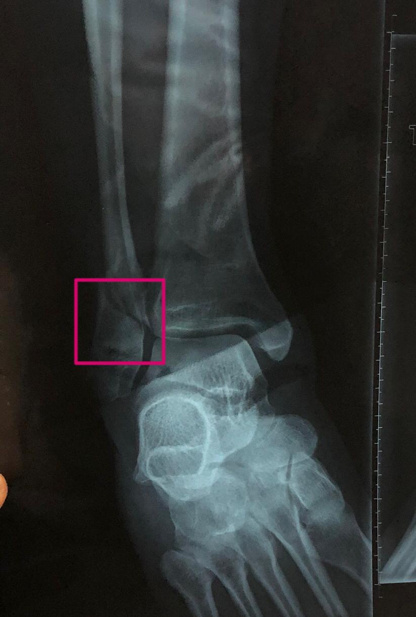 右踝关节外踝骨折图片图片