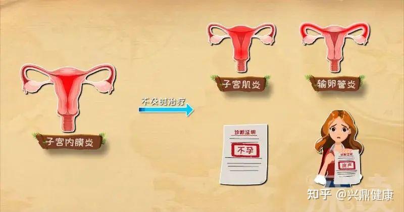 生动的子宫内膜炎症有什么症状的照片