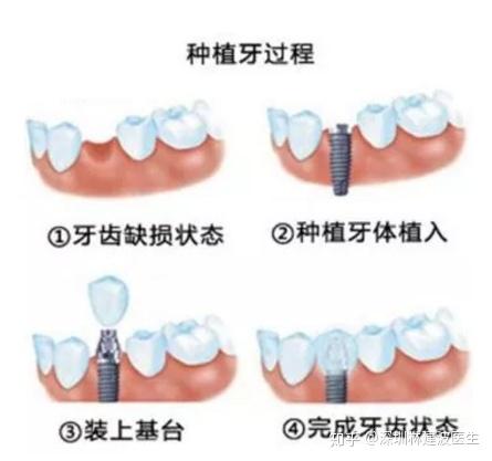 种植牙到底是怎么 种 的 种牙有哪些流程 种植牙术后5个阶段 有不同的护理保养方式 你知道吗 知乎