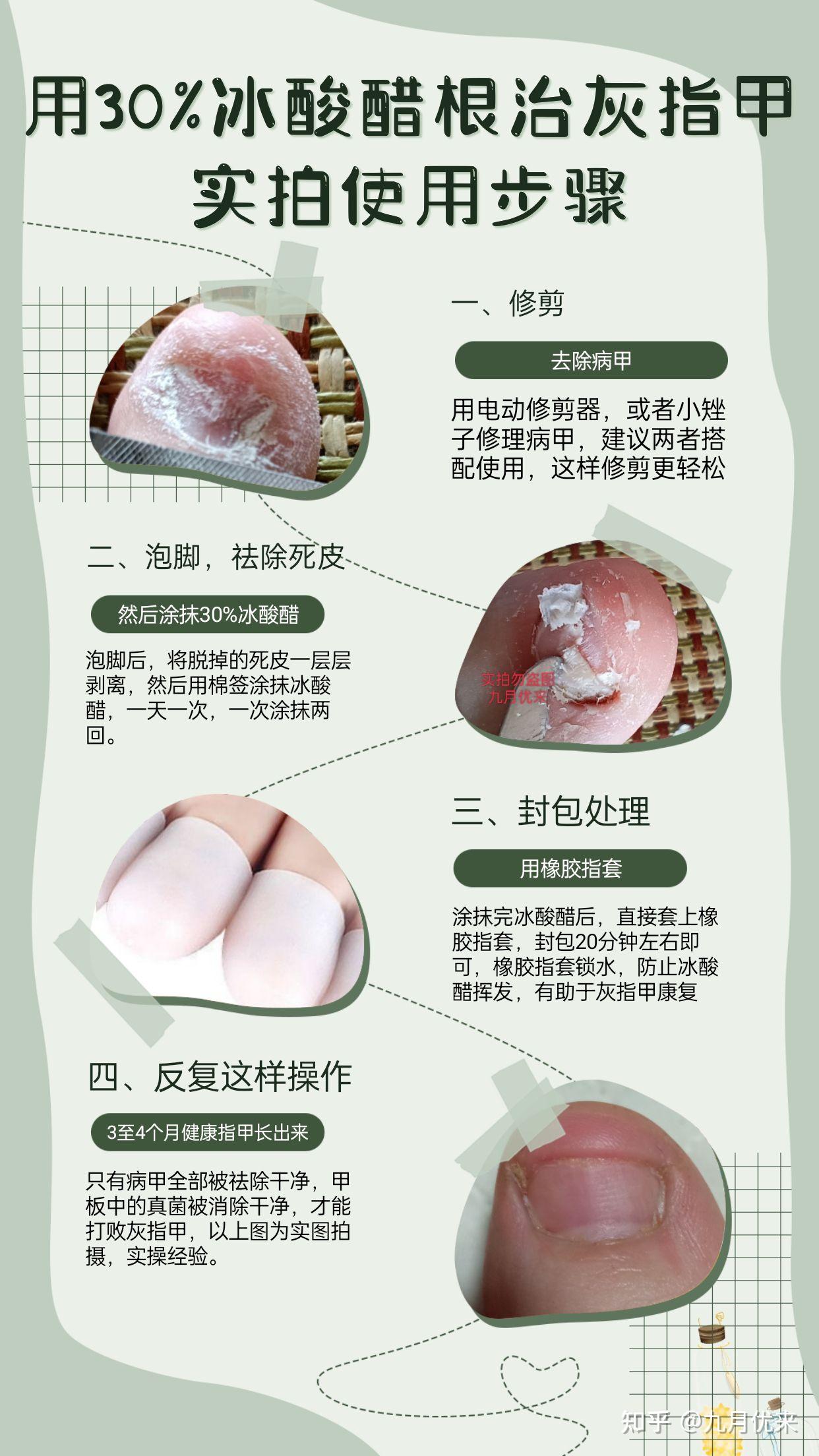 30%冰酸醋根治灰指甲的过程,全程实拍记录,告别真菌感染,手足癣,脚气