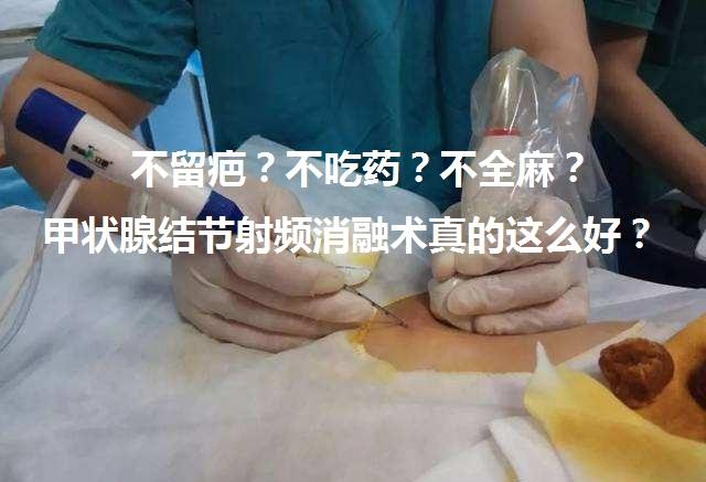 不留疤不吃藥不全麻甲狀腺結節射頻消融術真的這麼好