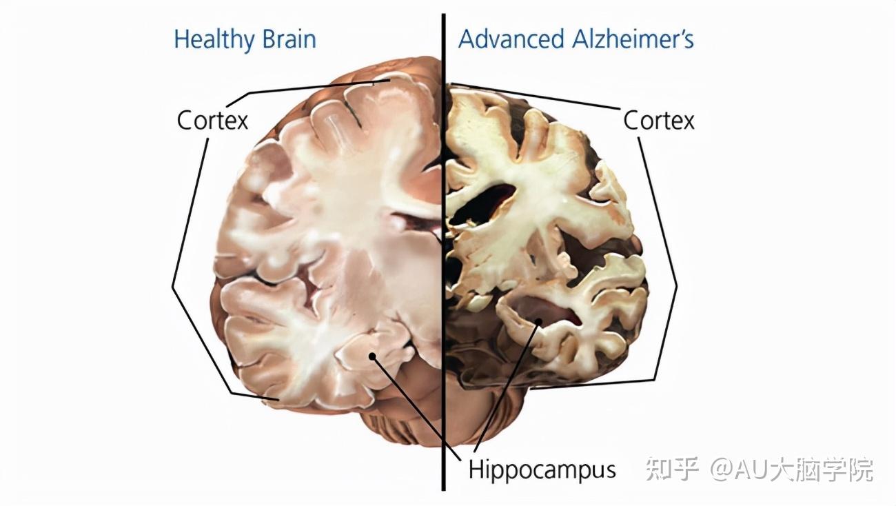 阿尔茨海默病大脑大脑皮层可以同样归属灰质 ,拥有丰富的神经细胞,为