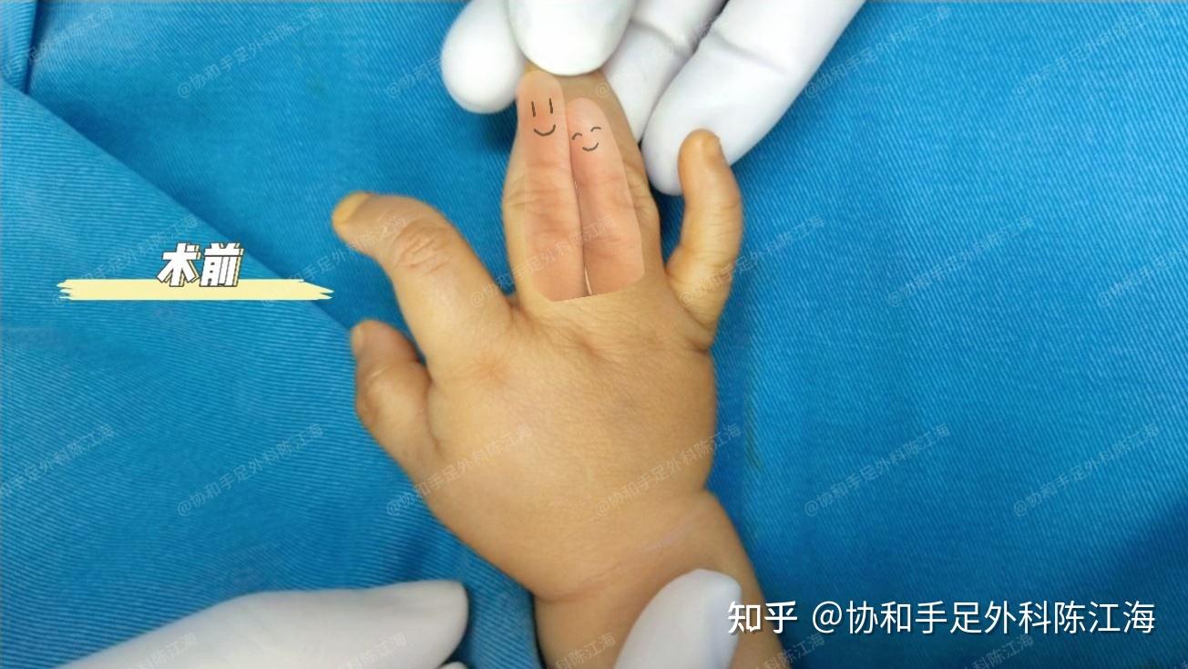 并指免植皮 | 案例14《“菱形”并指分开之后,小手力量很不错》 - 知乎