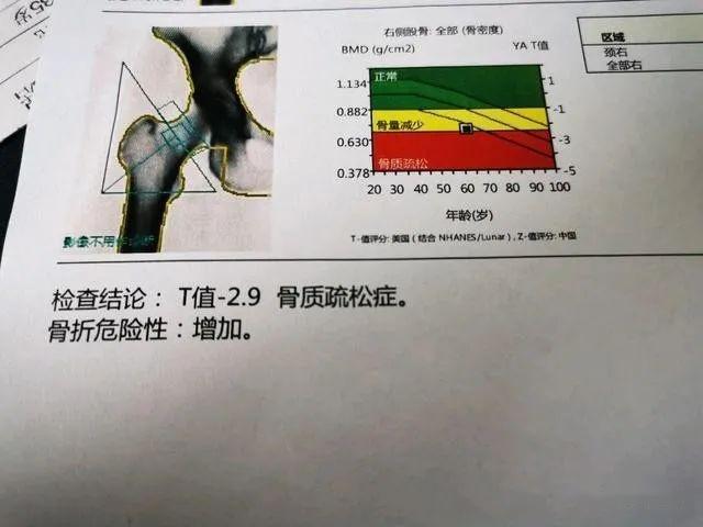 正常情況下,骨密度t值為-1.0至-2.