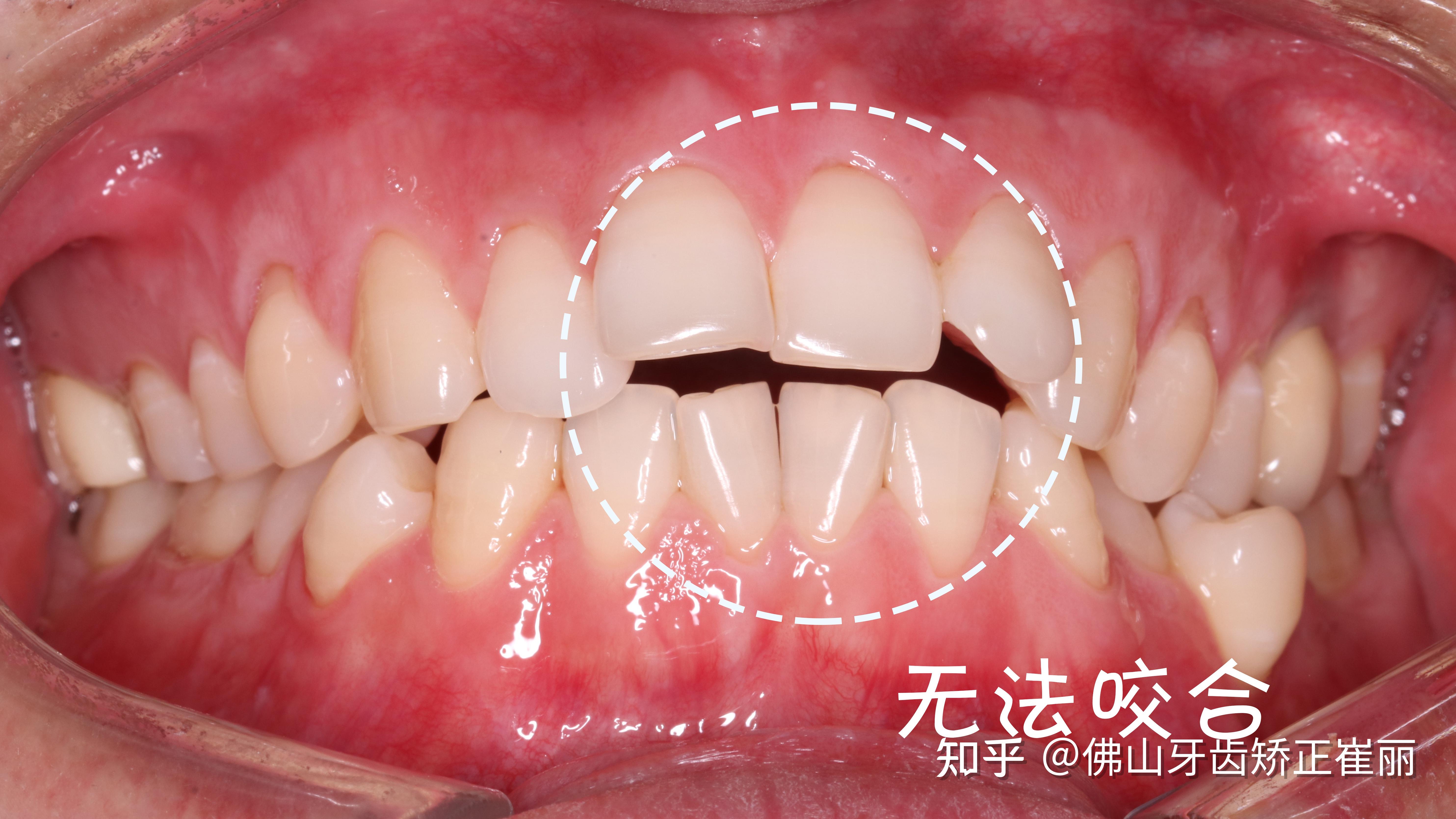 佛山牙齿矫正丨咬不断面条的开颌