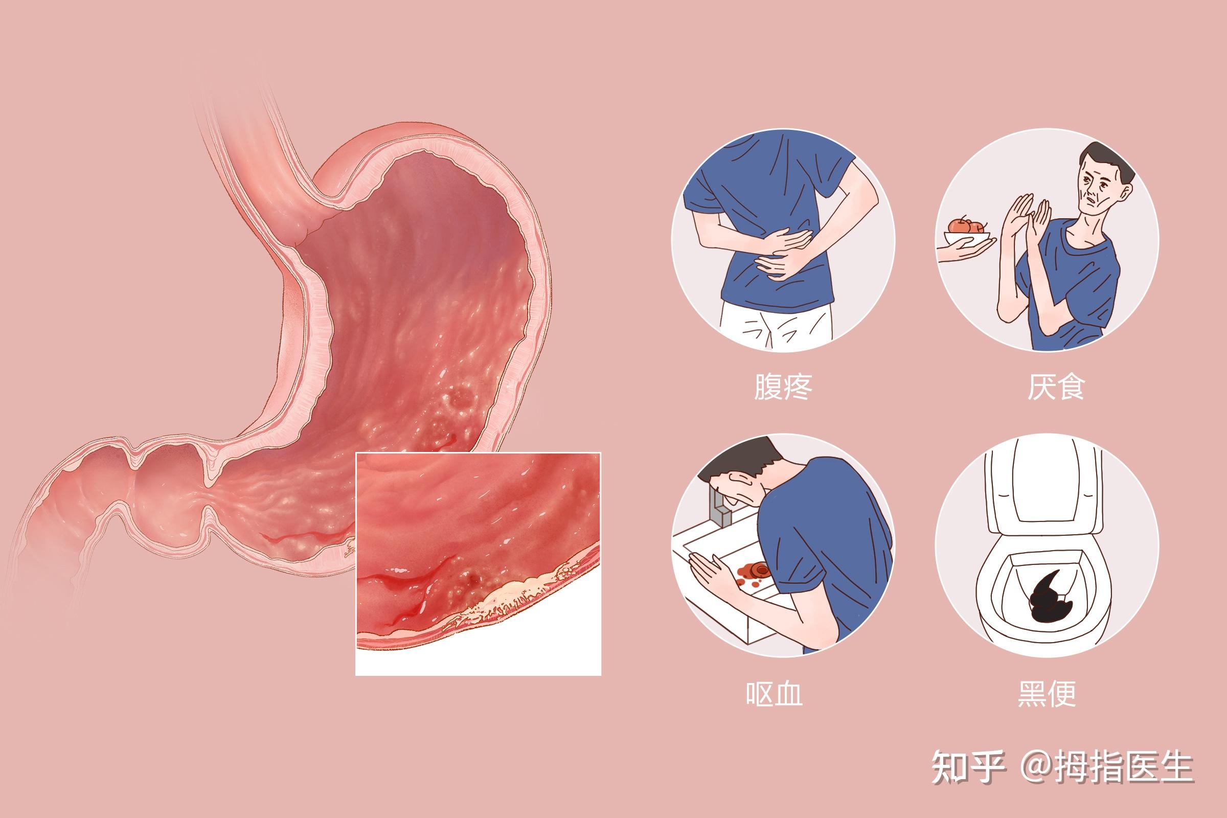 出現這些症狀要警惕胃癌在向你招手