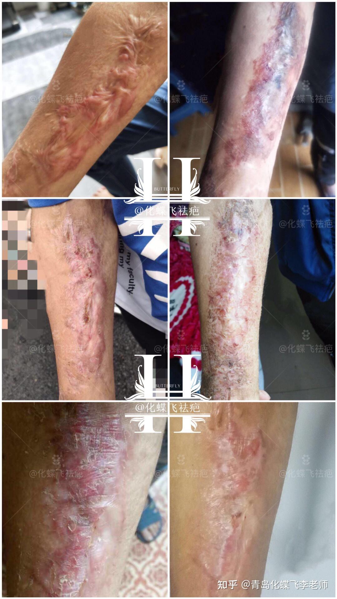 非常严重的烫伤增生疤痕