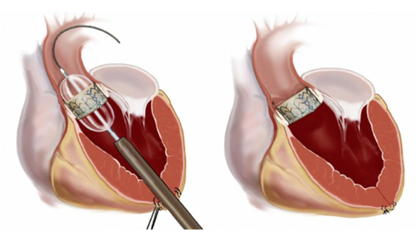 中高危的主动脉瓣重度狭窄患者不开刀就能治疗