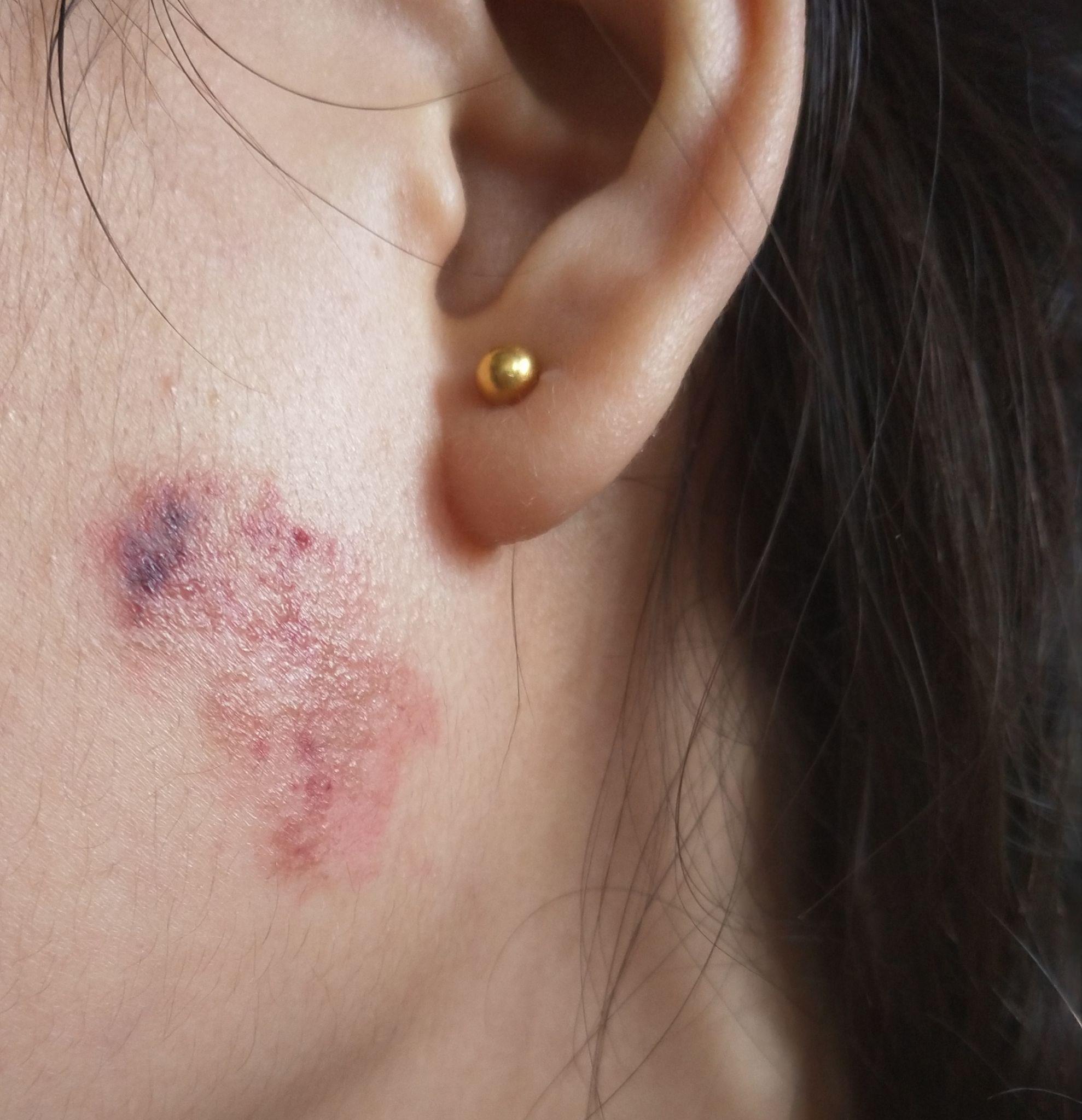 脸上有胎记是一种怎样的体验