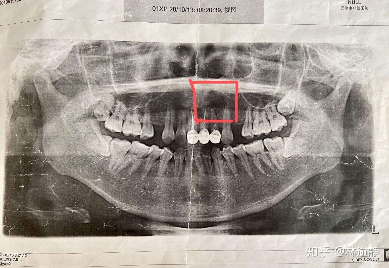 万万没想到,拆线完事之后大夫说,你这前牙有个根尖囊肿,还挺大的综上