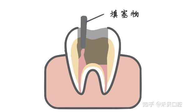 根尖诱导成形术是什么? - 知乎