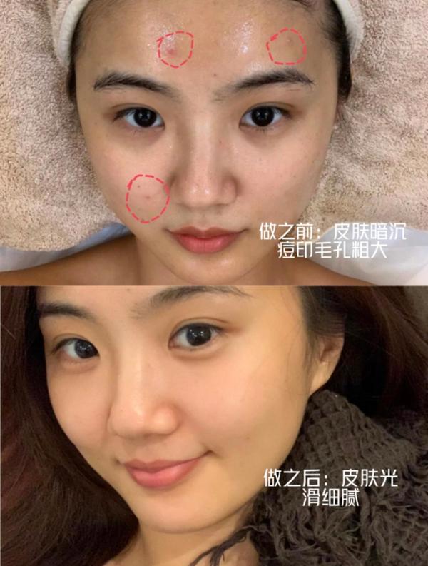 光子嫩肤避坑指南|IPL、AOPT、DPL怎么选？哪些人适合做都知道吗？ - 知乎