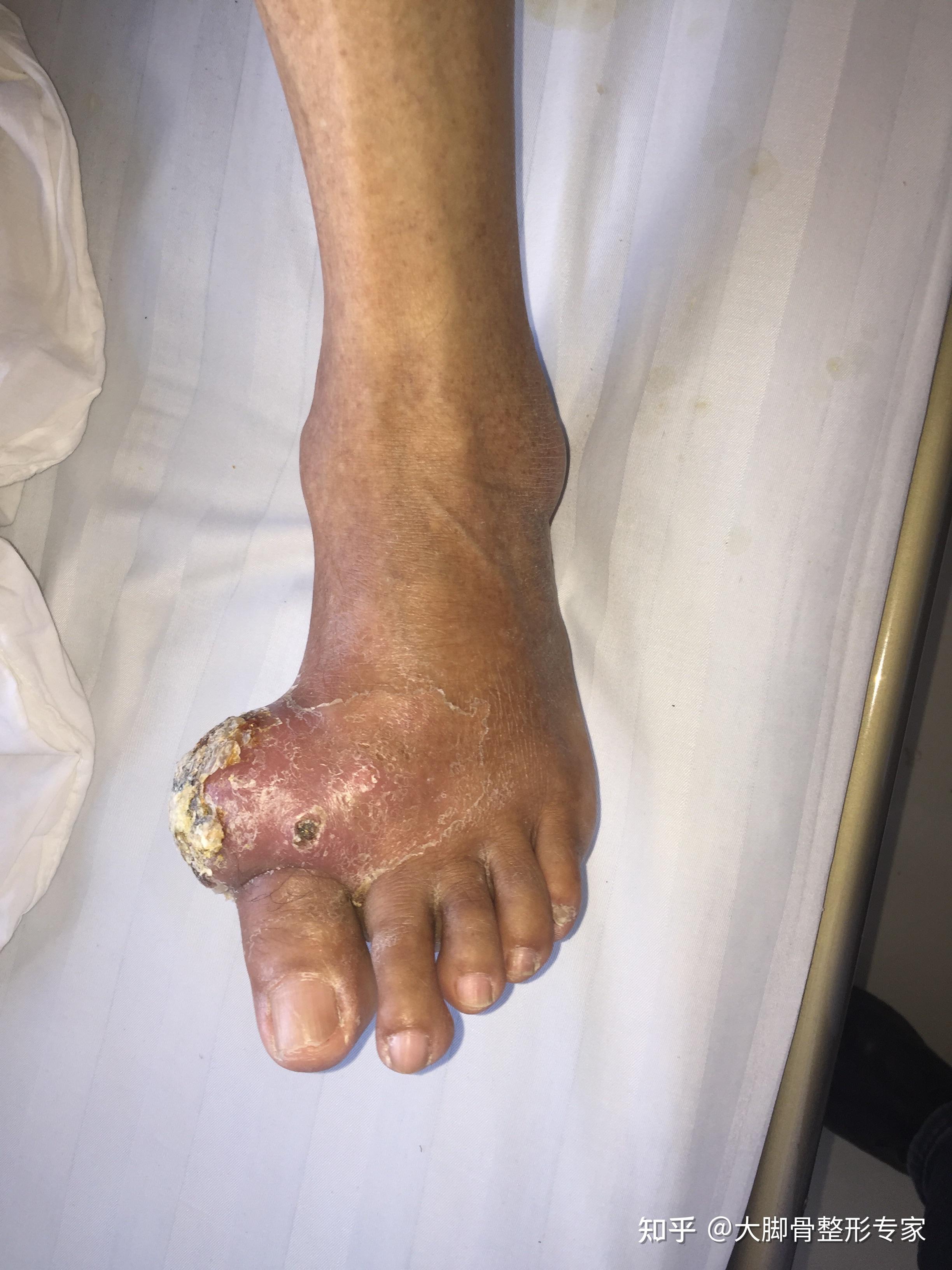 大脚骨手术真案例,湖南女孩拇外翻手术
