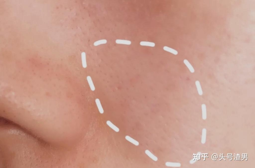 做好补水,收缩毛孔