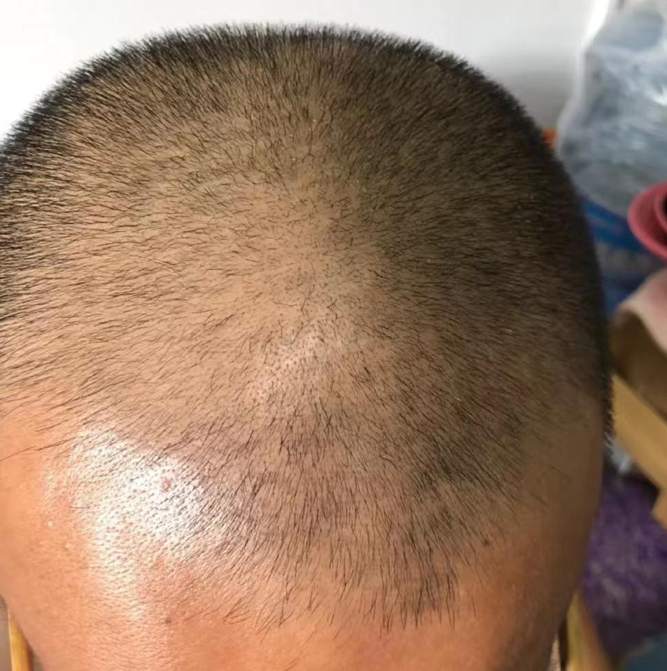 植发的缺陷(植发的坏处是什么?)