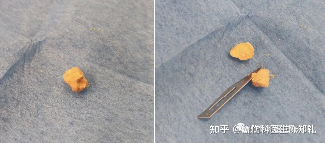 身上长了“火疖子”到底是怎么一回事? - 知乎
