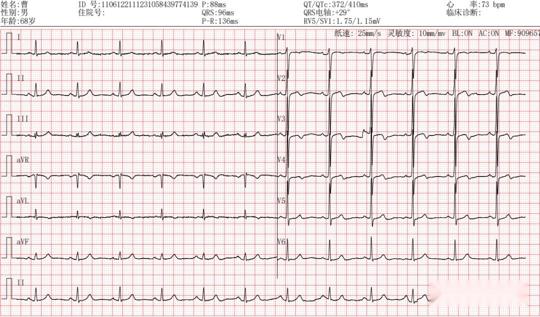 t波低平心电图图片