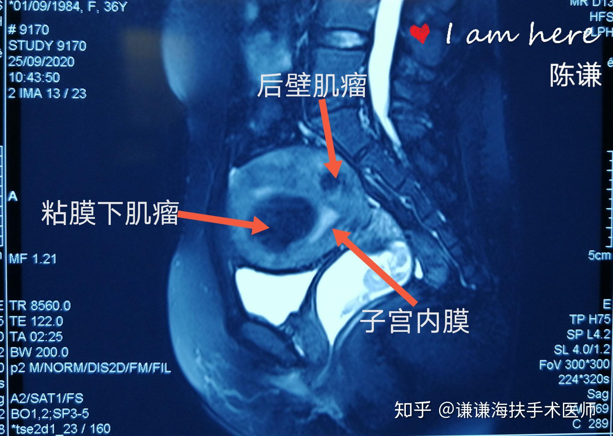 子宫颈转化区特征（2）--《子宫颈疾病——阴道镜图释》