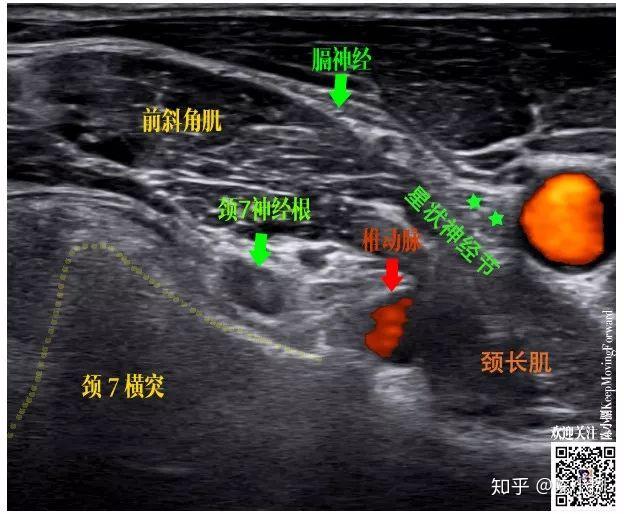 隐神经阻滞超声图图片