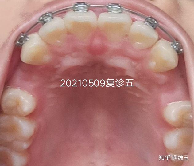 我也開始寫牙套記錄啦深覆合深覆蓋拔牙正畸金屬自鎖平導重慶19歲女生