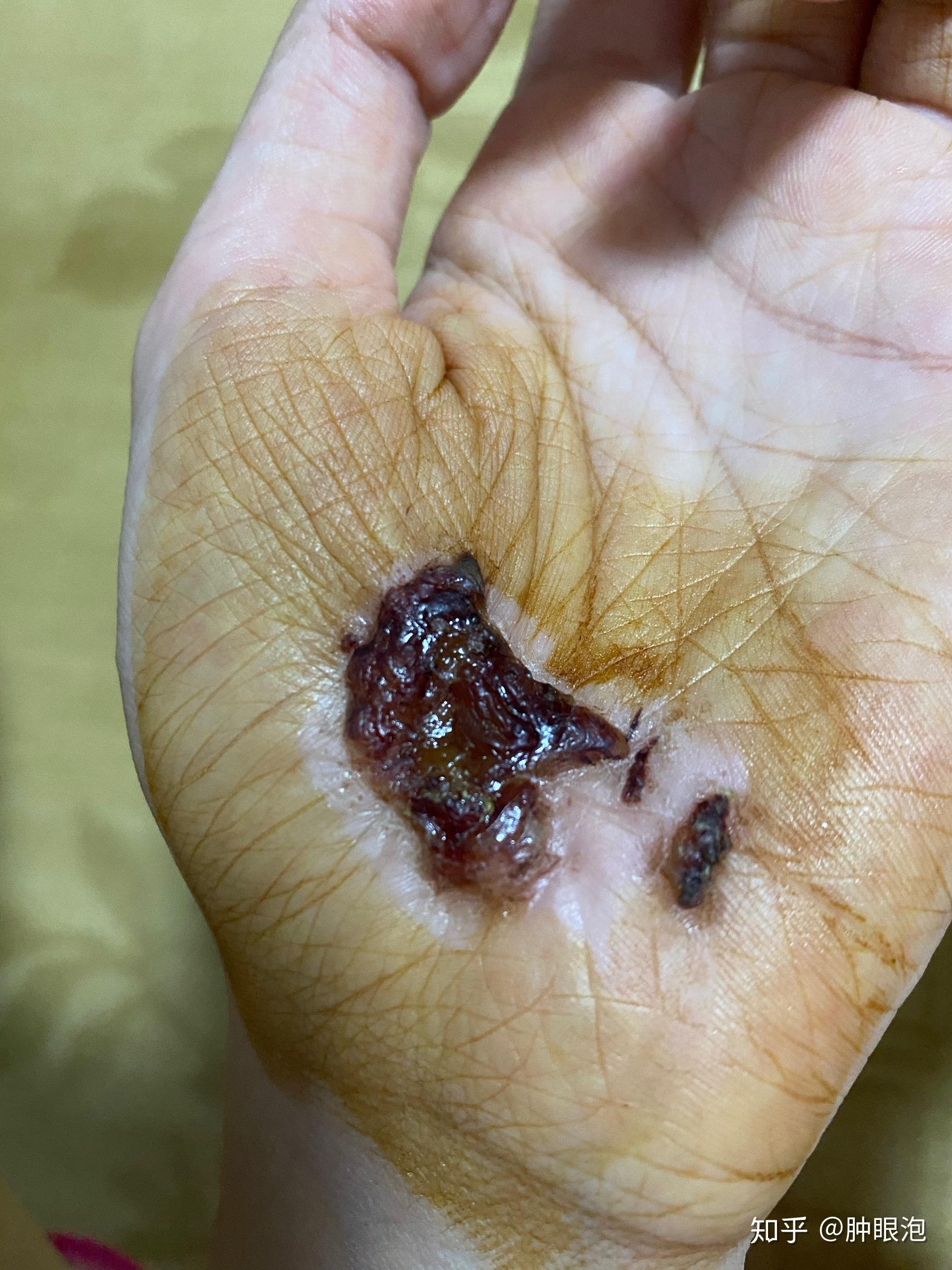 擦伤后的处理,伤口化脓了? - 知乎