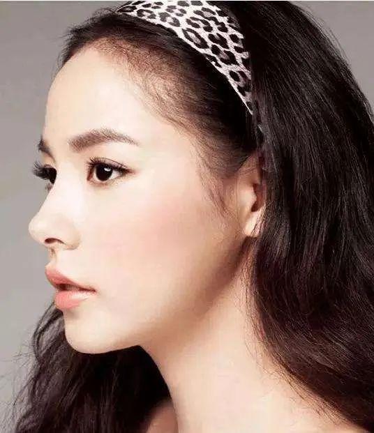 这样一看,鼻骨内推手术是不是比大家之前理解的单纯