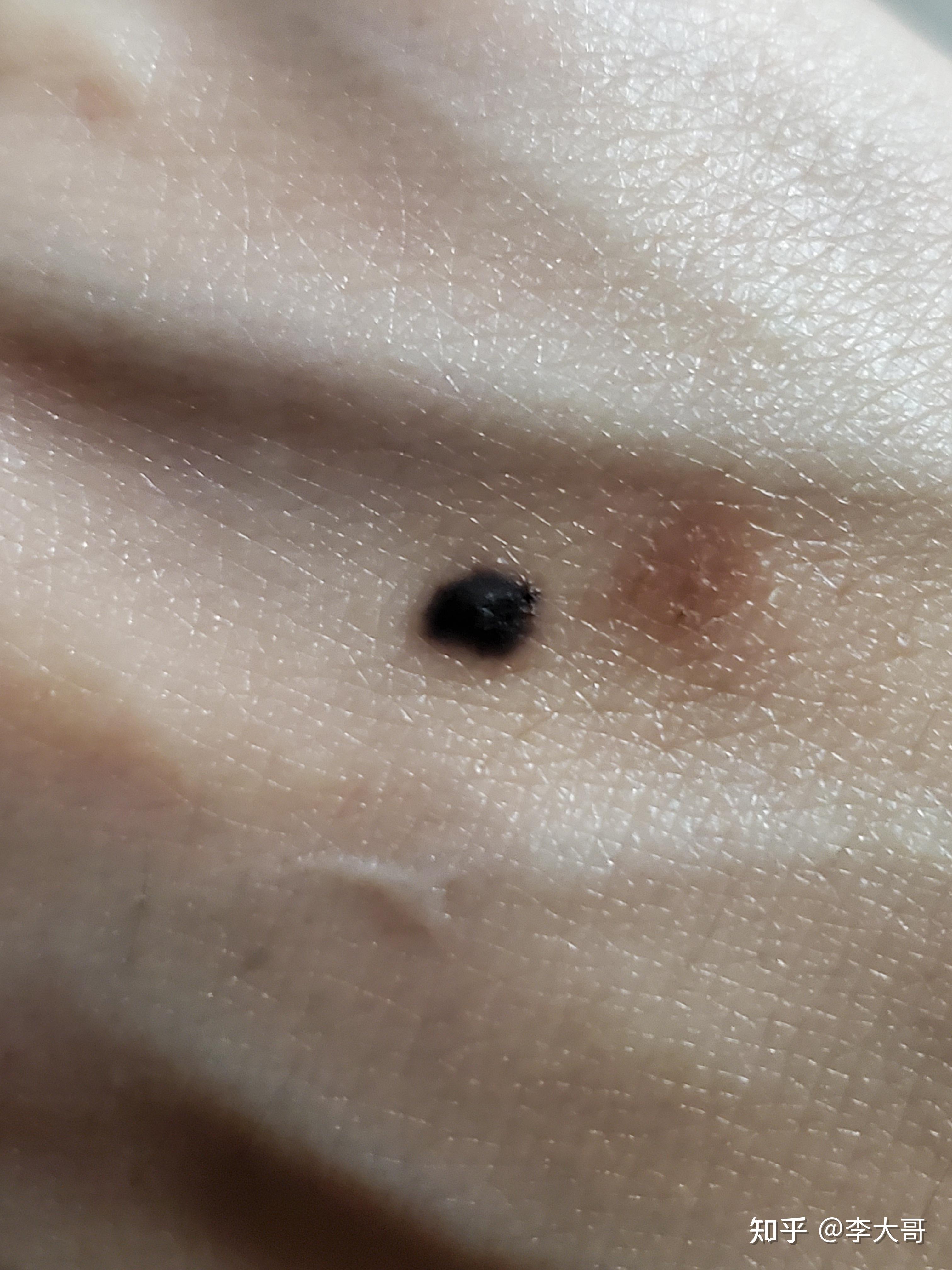 1期黑色素瘤图片自查图片