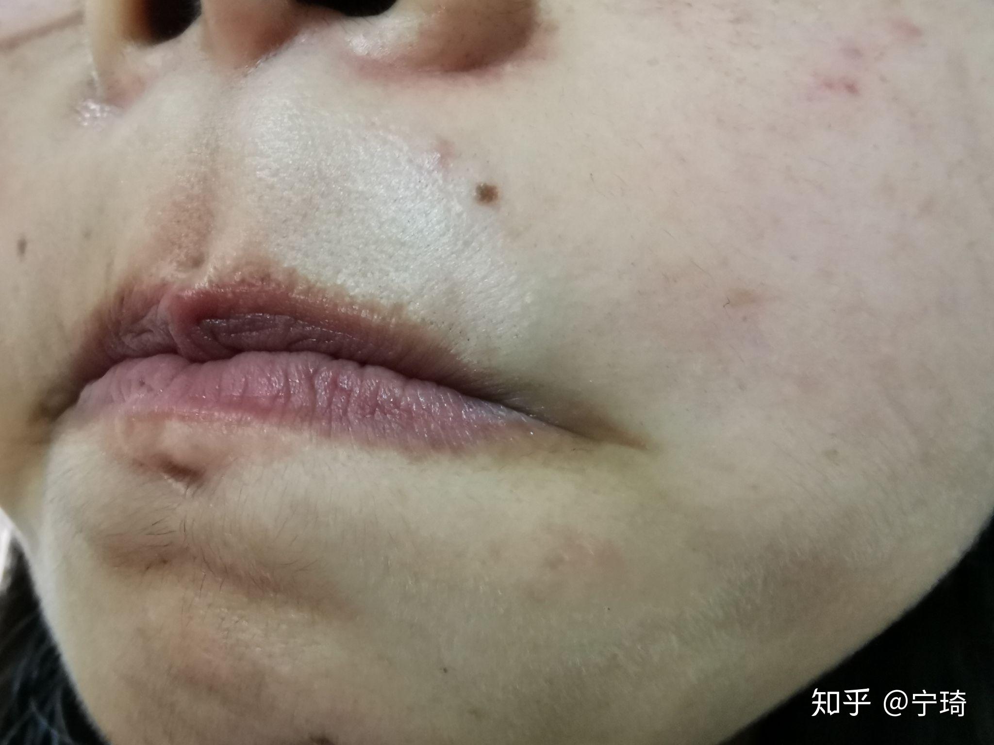脱唇毛记录